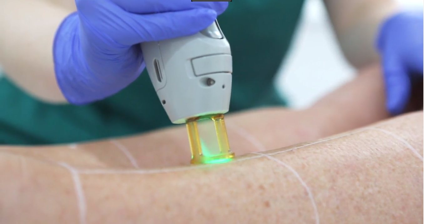 Laser hair removal