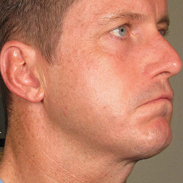 Ultherapy full face result at Meyer Clinic, after treatment