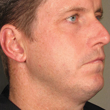 Ultherapy full face result at Meyer Clinic, before treatment