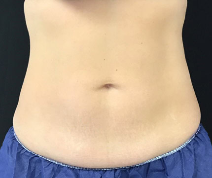 Female abdomen after CoolSculpting® | Meyer Clinic