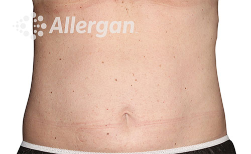 Female abdomen after CoolSculpting® | Meyer Clinic