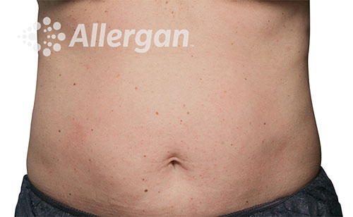 Female abdomen before CoolSculpting® | Meyer Clinic