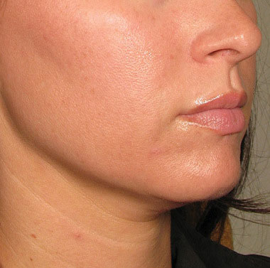 Chin after Ultherapy® | Meyer Clinic