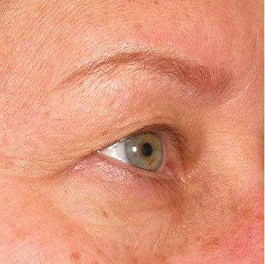 Brow before Ultherapy® | Meyer Clinic
