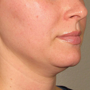 Chin before Ultherapy® | Meyer Clinic