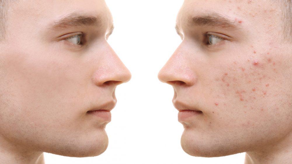 A side profile reveals the same person: one side showing clear skin, while the other exhibits acne, a common struggle many faced during lockdown. - Meyer Clinic