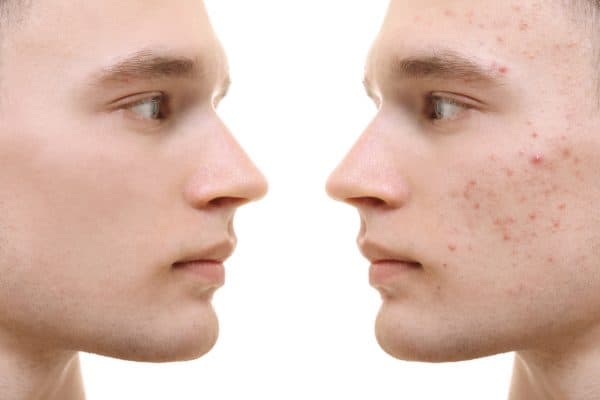 A side profile reveals the same person: one side showing clear skin, while the other exhibits acne, a common struggle many faced during lockdown. - Meyer Clinic