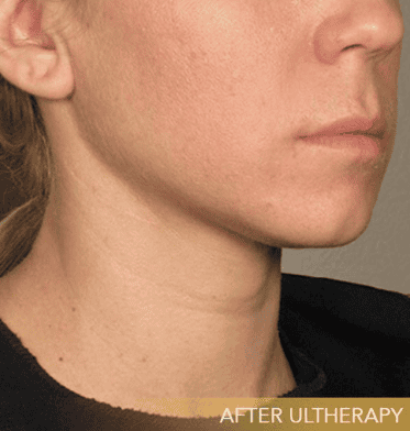 Close-up of a persons jaw and neck before and after Ultherapy treatment, showing improved skin tightness and texture. - Meyer Clinic