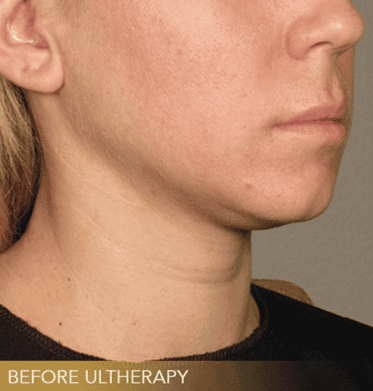 Close-up of a persons jawline and neck, showing skin texture, labeled Before Ultherapy in the bottom left corner. - Meyer Clinic