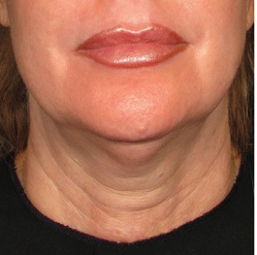 Close-up of a person’s lower face with prominent lips and visible neck wrinkles. - Meyer Clinic