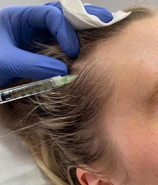 A gloved hand carefully administers a Platelet Rich Plasma injection to a persons scalp, targeting the hairline. - Meyer Clinic