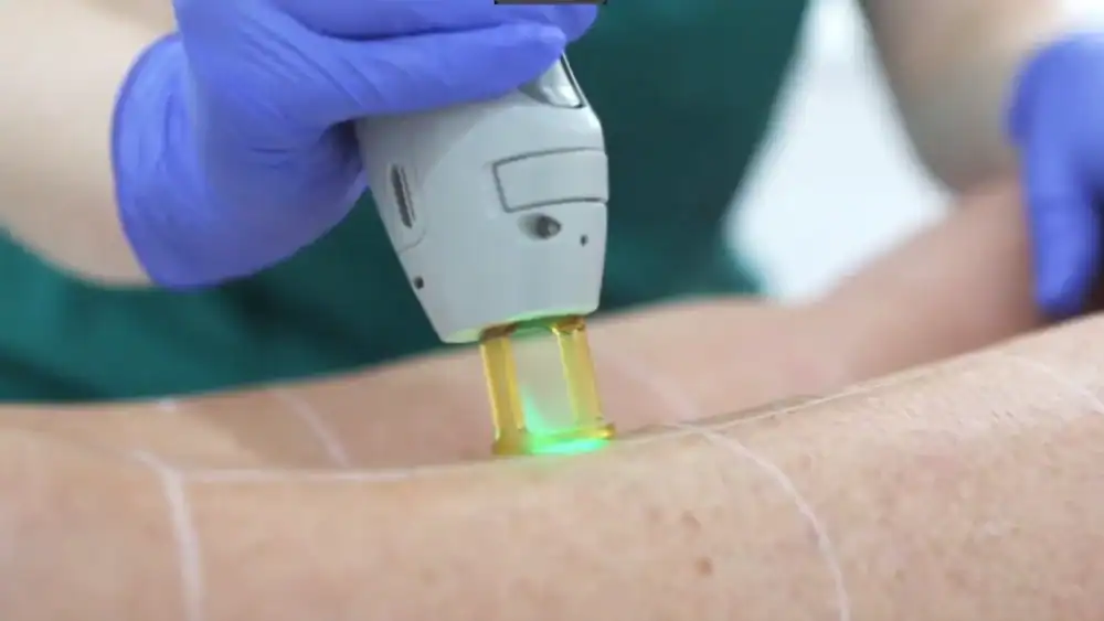 Pain-Free Laser Hair Removal